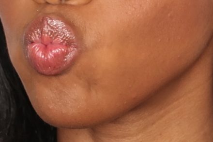 dry lips